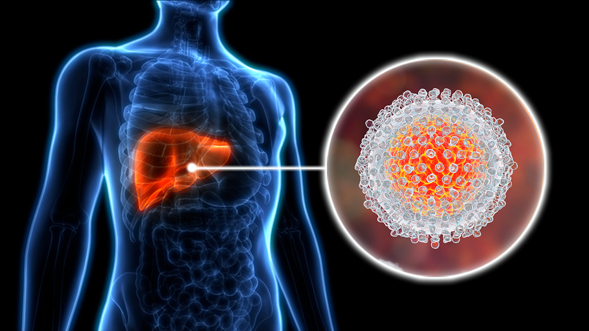 ما هو التهاب الكبد الوبائي (Hepatitis C)؟